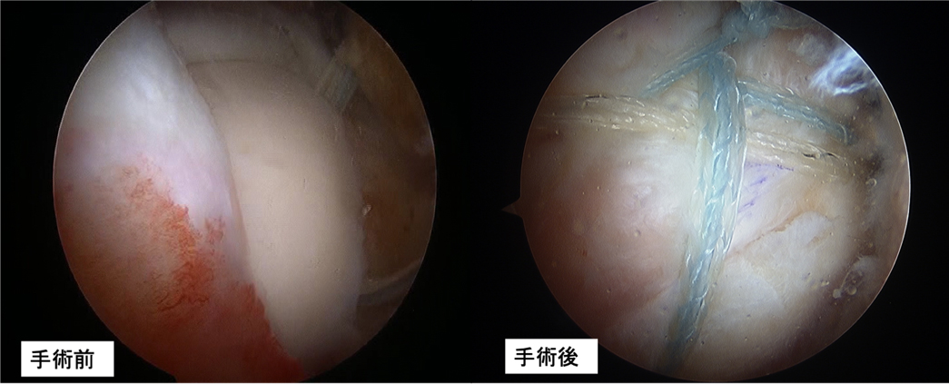図2 関節鏡による腱板修復術