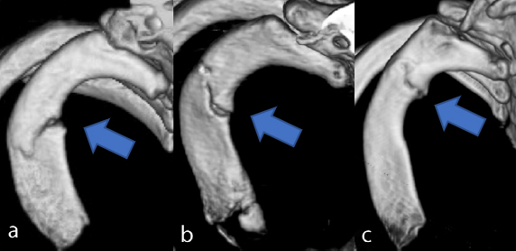 図5 投球動作による第一肋骨疲労骨折（Funakoshi et al. JBJS 2019より）	