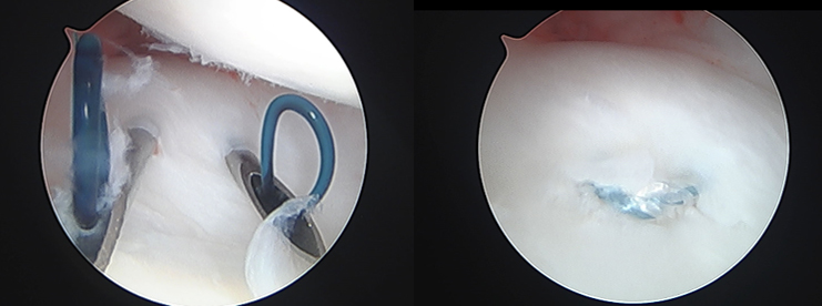 関節鏡視下TFCC関節包縫合術