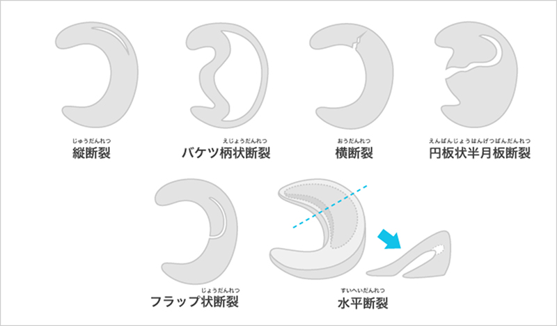 図2 半月板の損傷形態