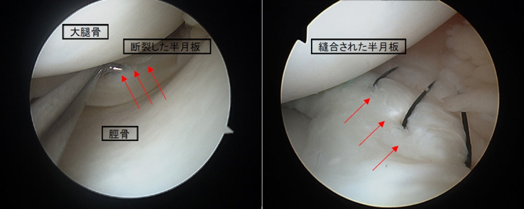 図1 MRIでみた半月板