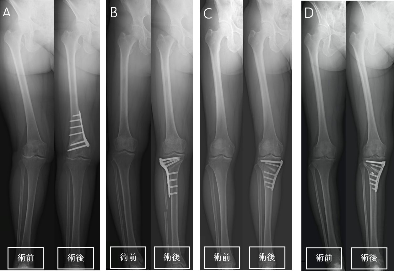 図5 各術式の手術前後のX線(下肢全長)
