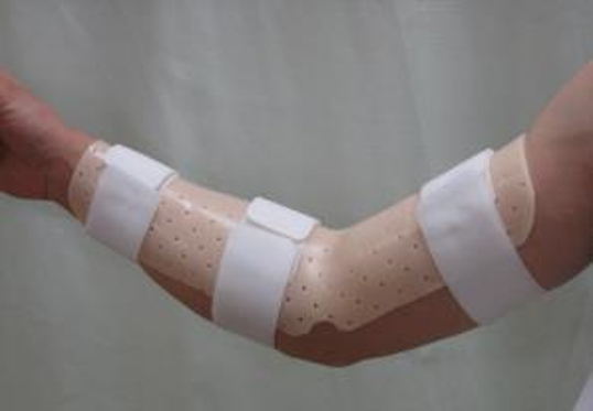 図11 簡易型プラスチック装具による固定